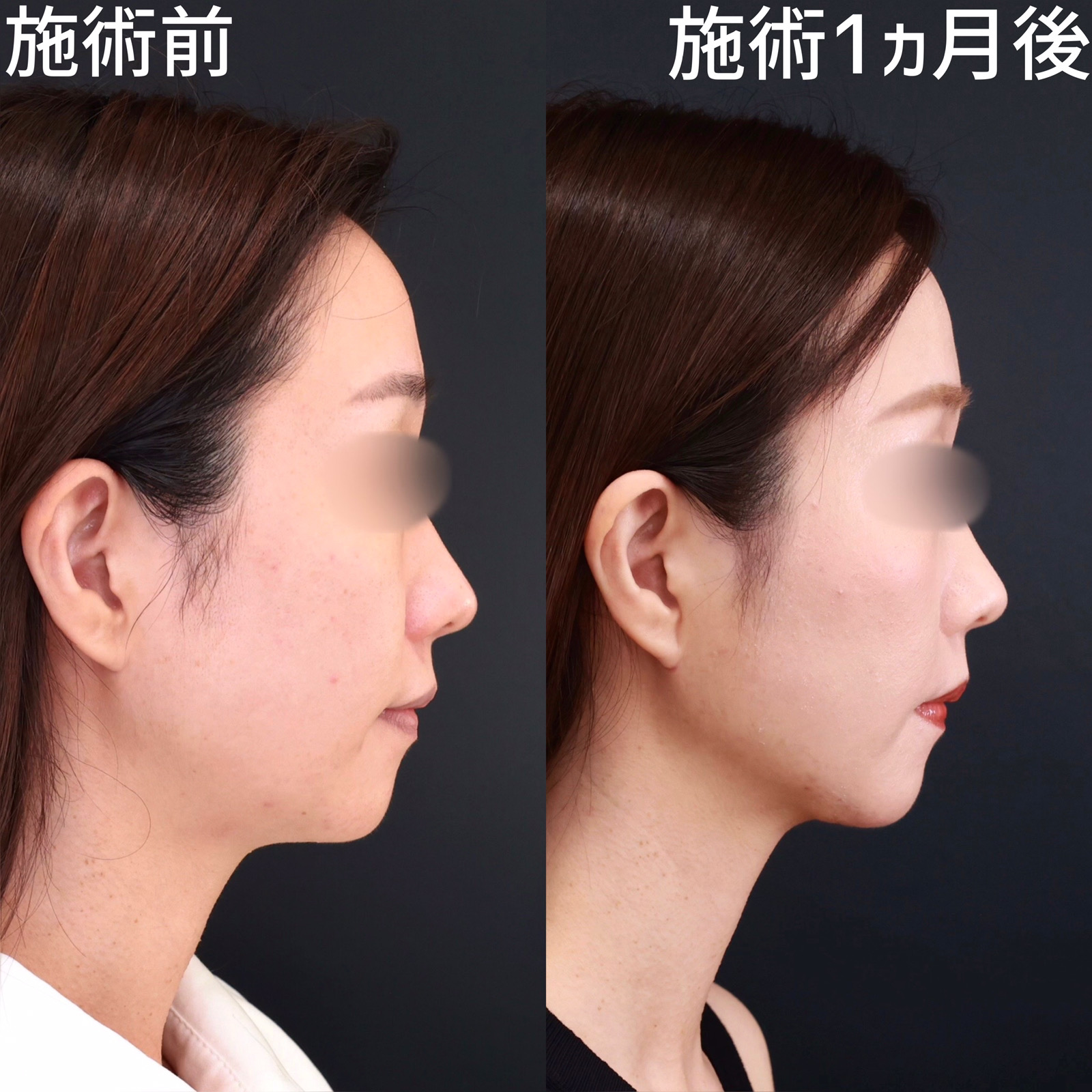 【糸リフト×顎下脂肪吸引】顎下の余分な脂肪を除去してスッキリ小顔に！