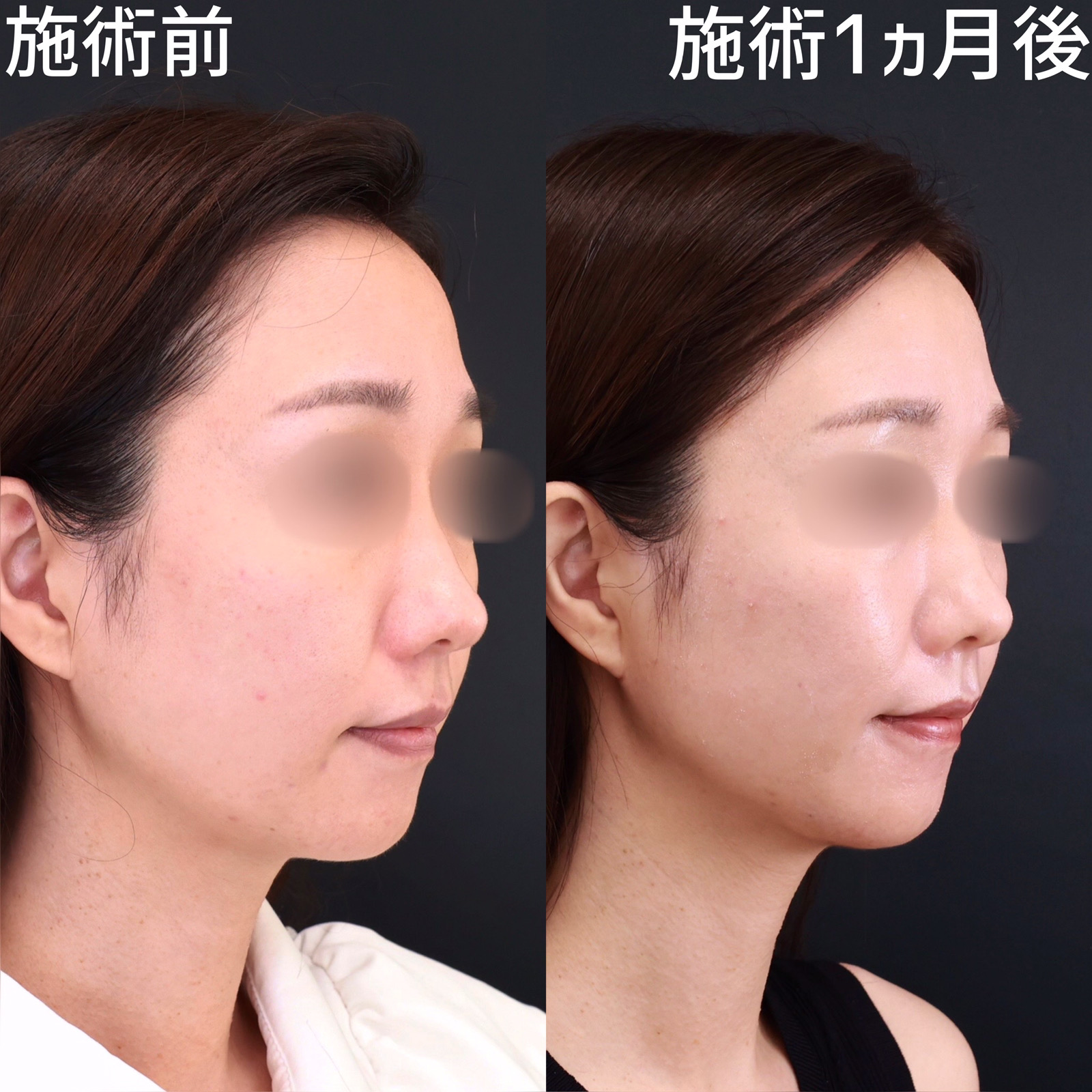 TAC式 ツヤ肌コラーゲンリフト®/顔の脂肪吸引/ほうれい線のヒアルロン酸注射の症例写真 施術前後 