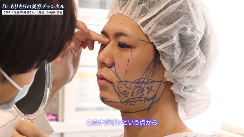 鼻へのヒアルロン酸注入位置を確認