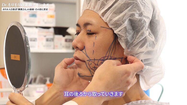 脂肪吸引の位置を確認