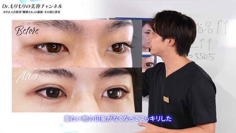 埋没法で重いまぶたが解消し、目元が明るくなった様子の比較写真