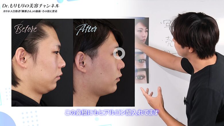 鼻根へのヒアルロン酸注入で、横顔のラインが綺麗になった比較写真