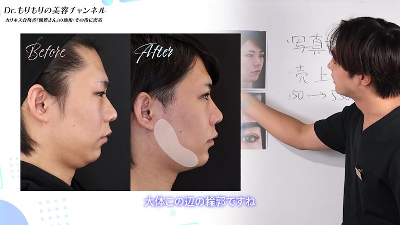 小顔施術でフェイスラインが劇的にシャープになった横顔の比較写真