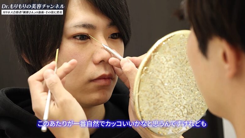 楓雅さんの二重の幅をシミュレーションする森医師