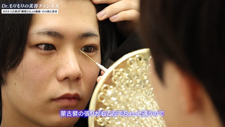 左右の蒙古襞の張りを確認する森医師