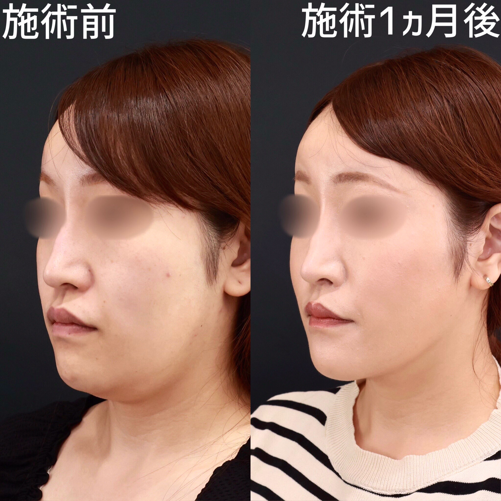 【糸リフト×顎下脂肪吸引】二重顎をスッキリ解消！