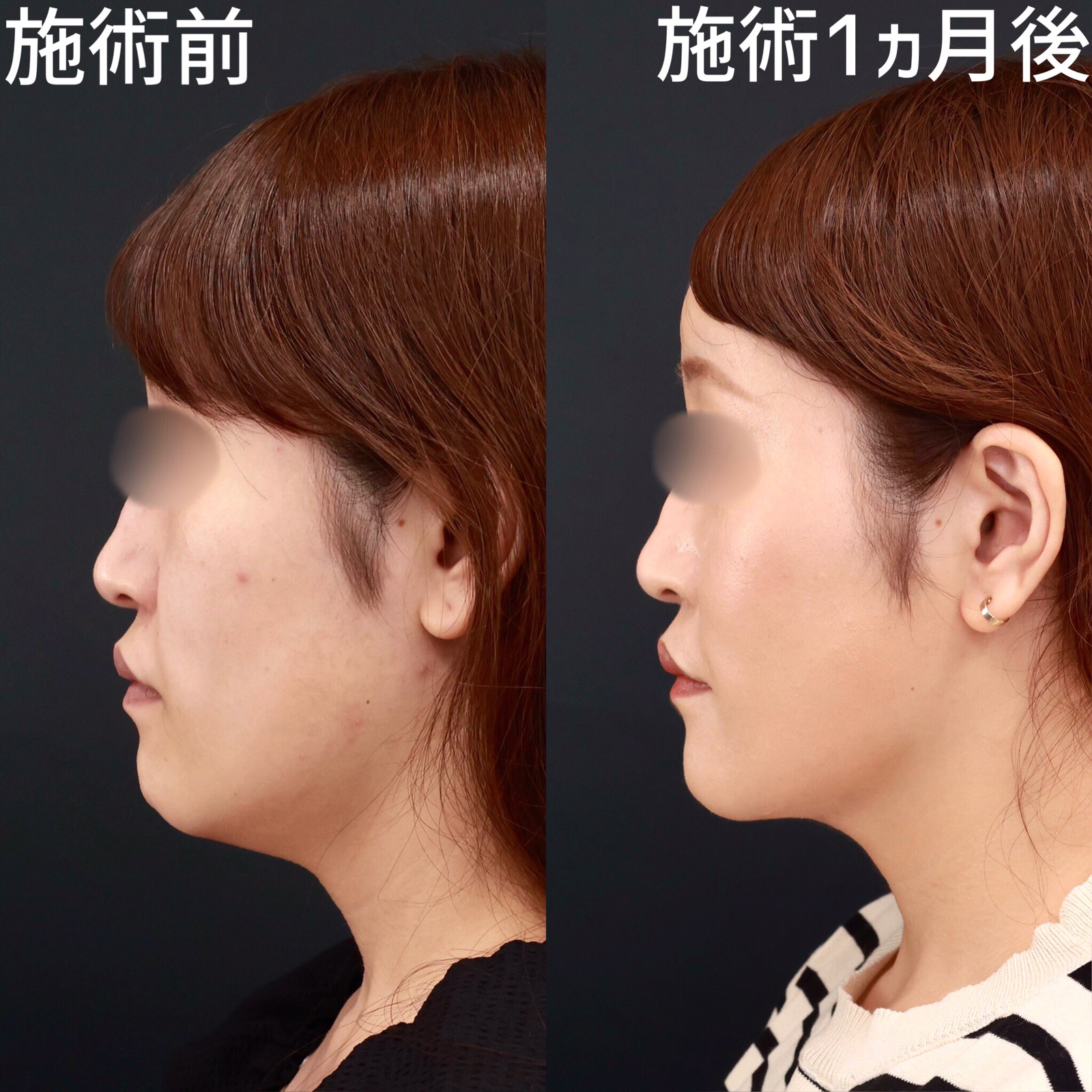 顔の脂肪吸引/Lラインファット除去（エラ下脂肪除去）/エラボトックス注射の症例写真 施術前後 