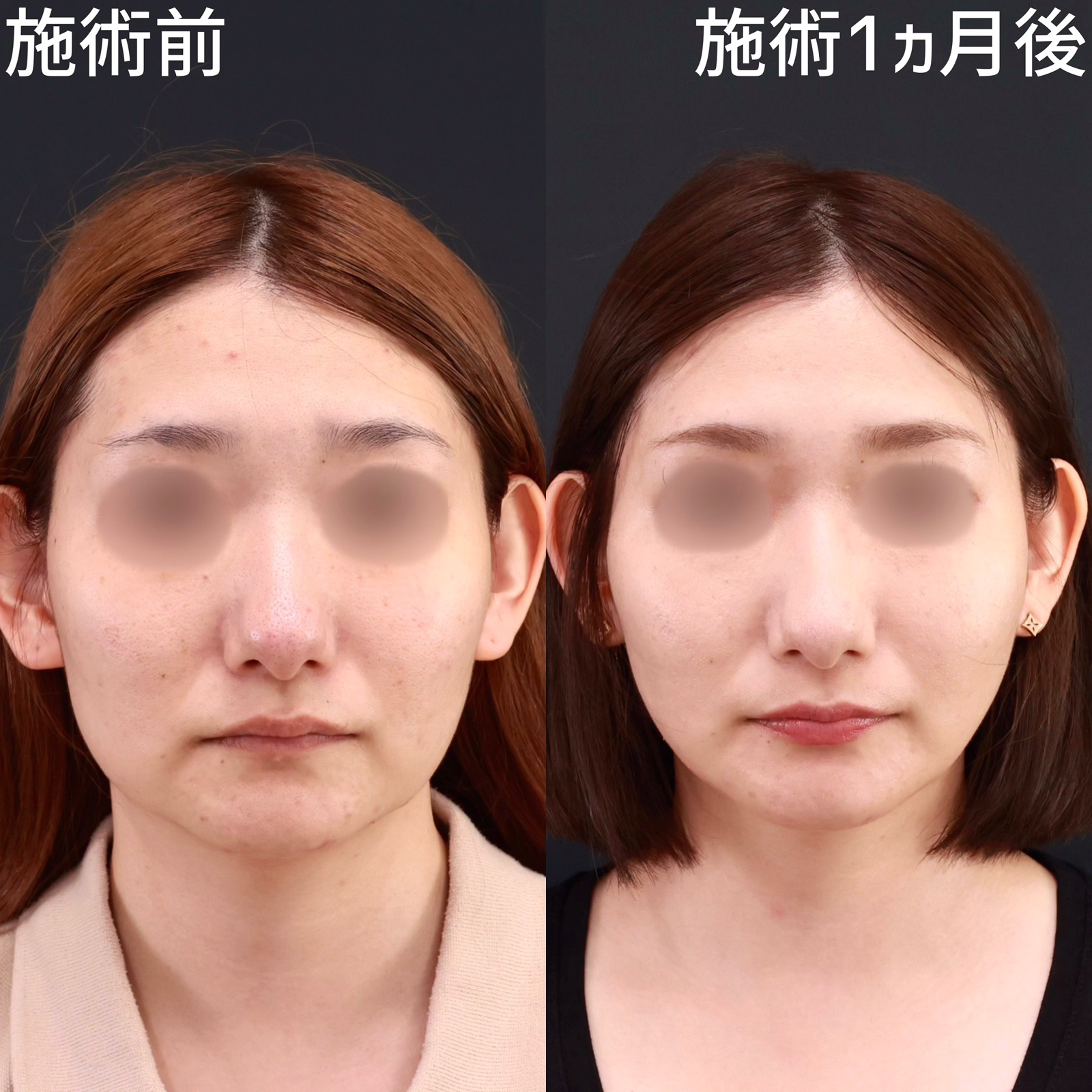 【糸リフト×エラボツリヌストキシン】四角い輪郭を卵型に整える！