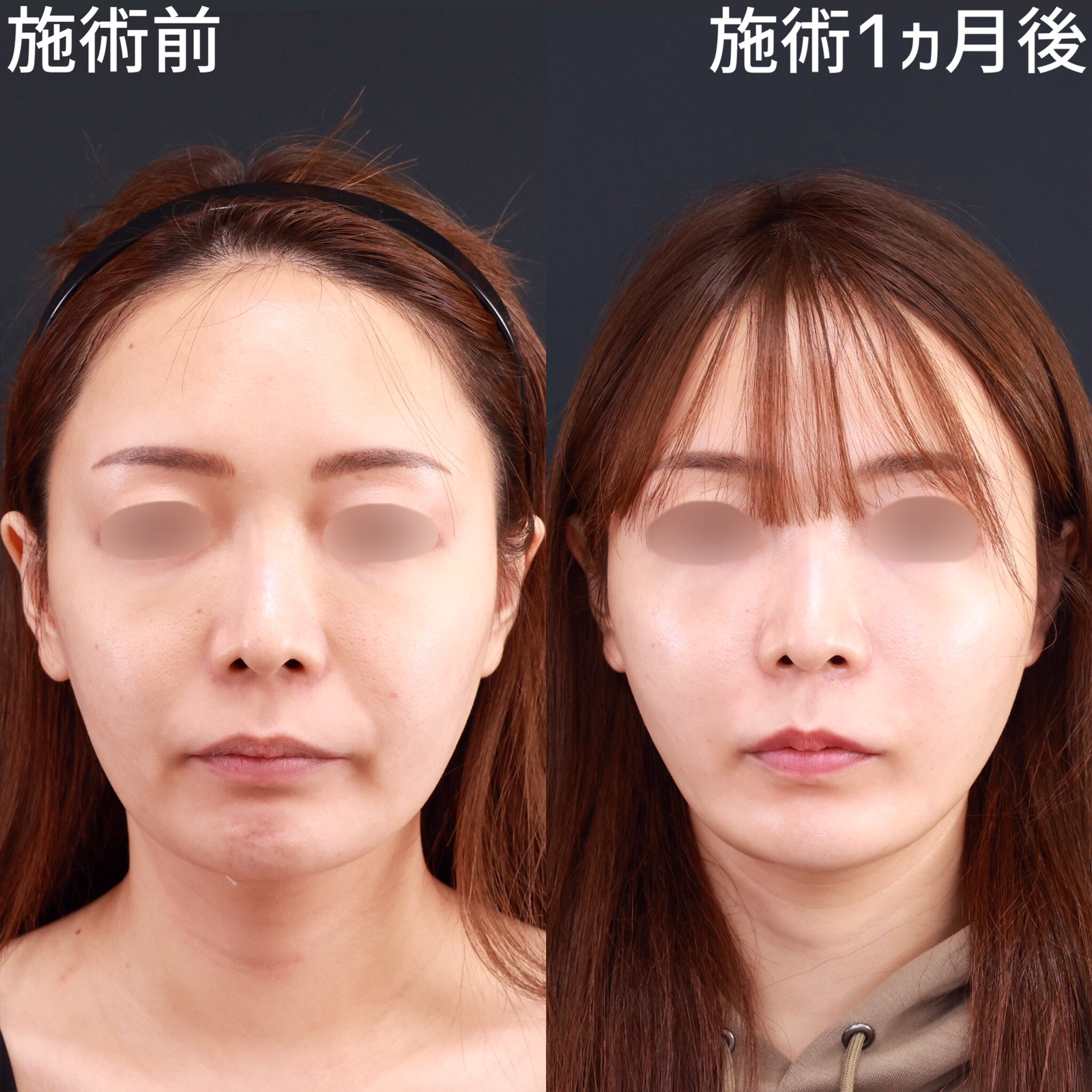 【糸リフト×脂肪除去】口元のもたつきを除去して自然な若返り！