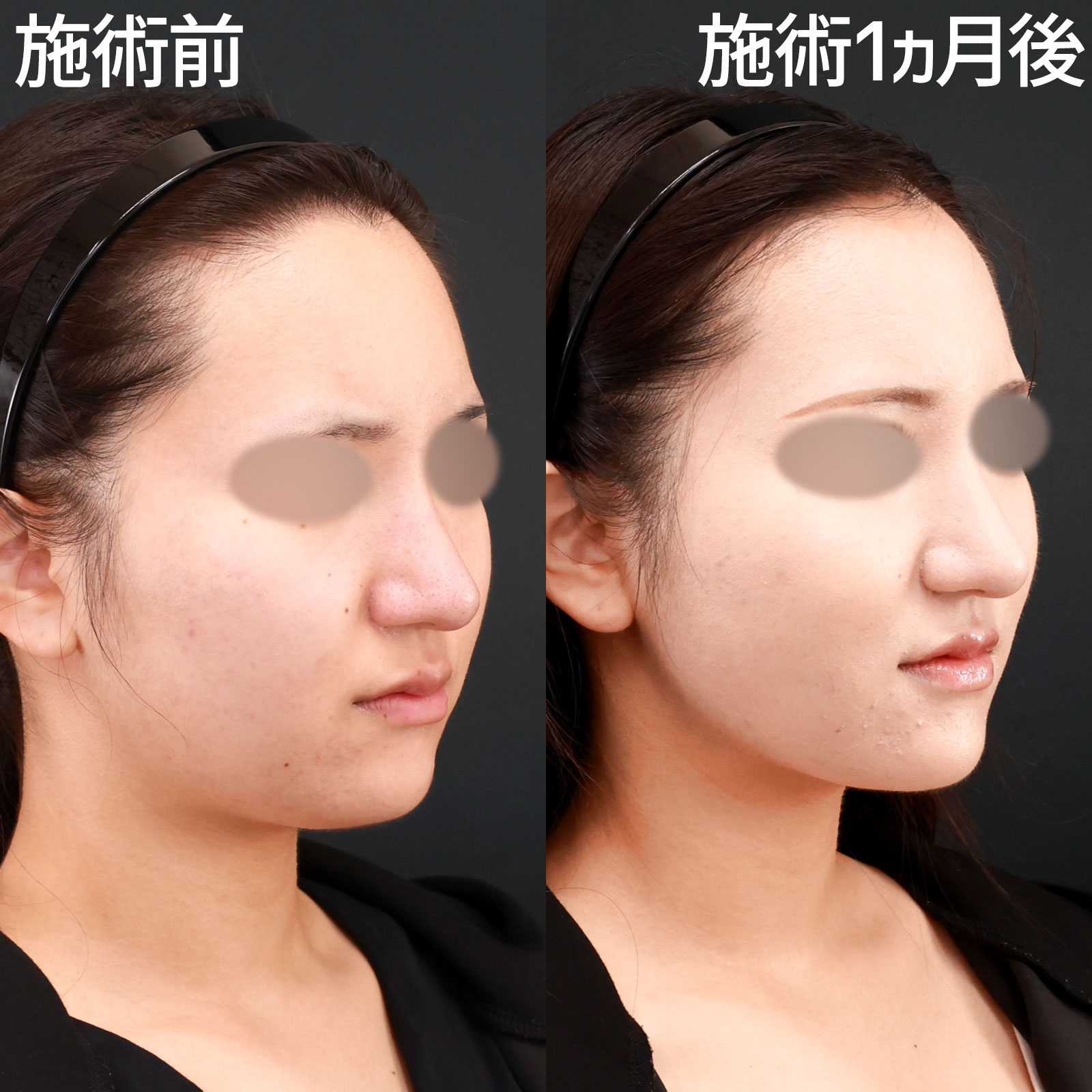 ジョールファット除去/顎下の脂肪吸引・顔の脂肪吸引/Lラインファット除去（エラ下脂肪除去）の症例写真 施術前後 