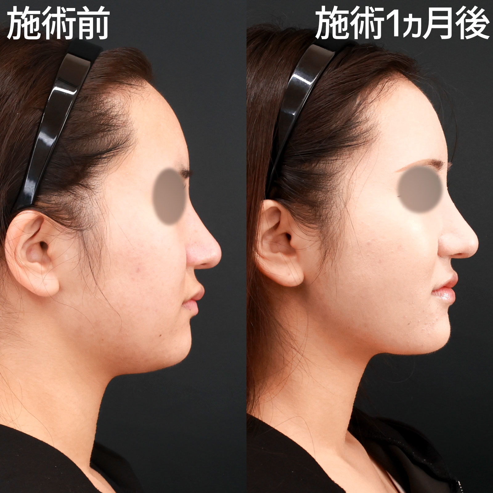 ジョールファット除去/顎下の脂肪吸引・顔の脂肪吸引/Lラインファット除去（エラ下脂肪除去）の症例写真 施術前後 