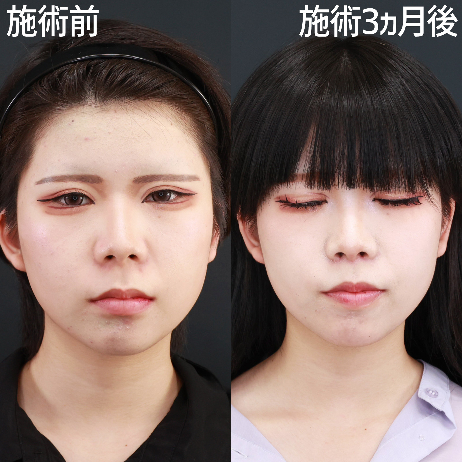 【人中短縮術】鼻の下を短くすると、お顔全体が引き締まった印象に