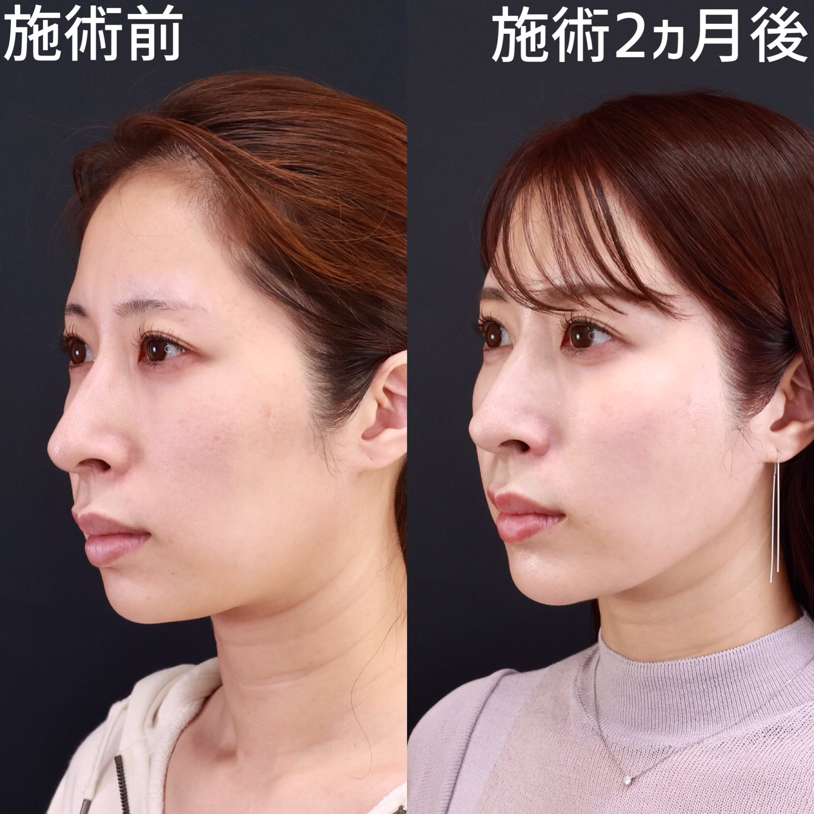 【糸リフト×Lラインファット除去】クッキリ美しい輪郭に！