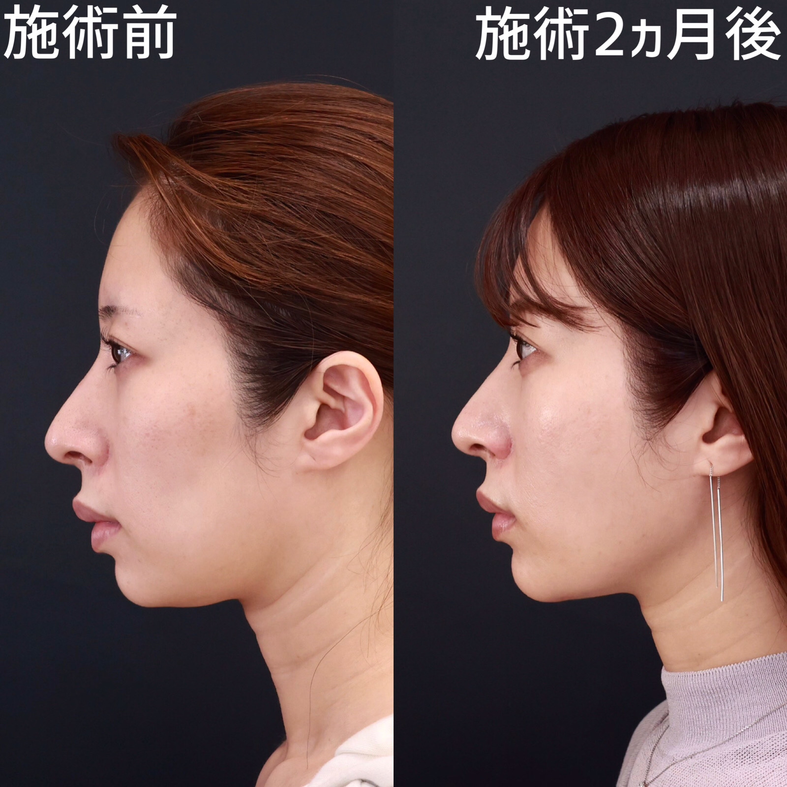 TAC式 ツヤ肌コラーゲンリフト®/顔の脂肪吸引/Lラインファット除去（エラ下脂肪除去）の症例写真 施術前後 