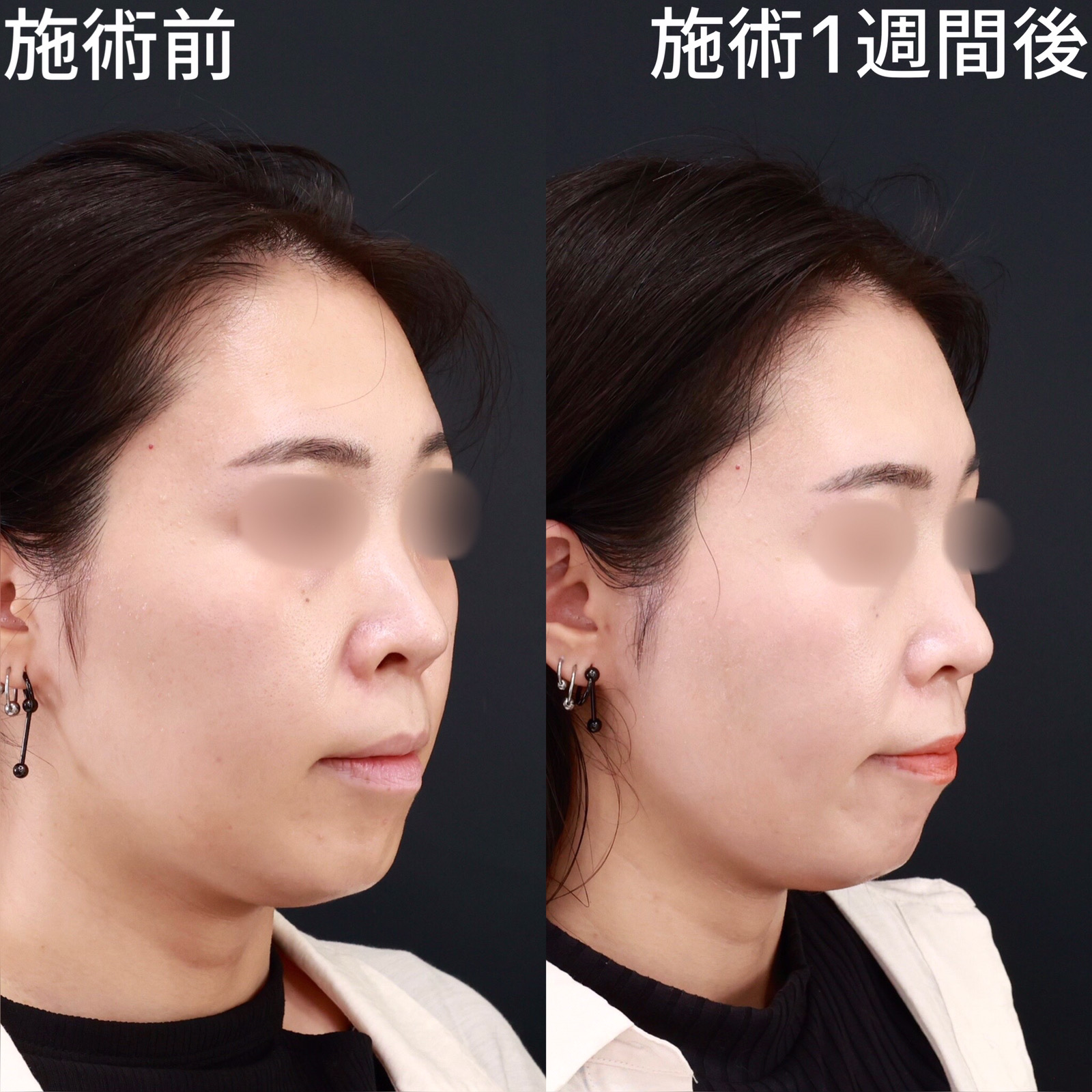 TAC式 ツヤ肌コラーゲンリフト®の症例写真 施術前後