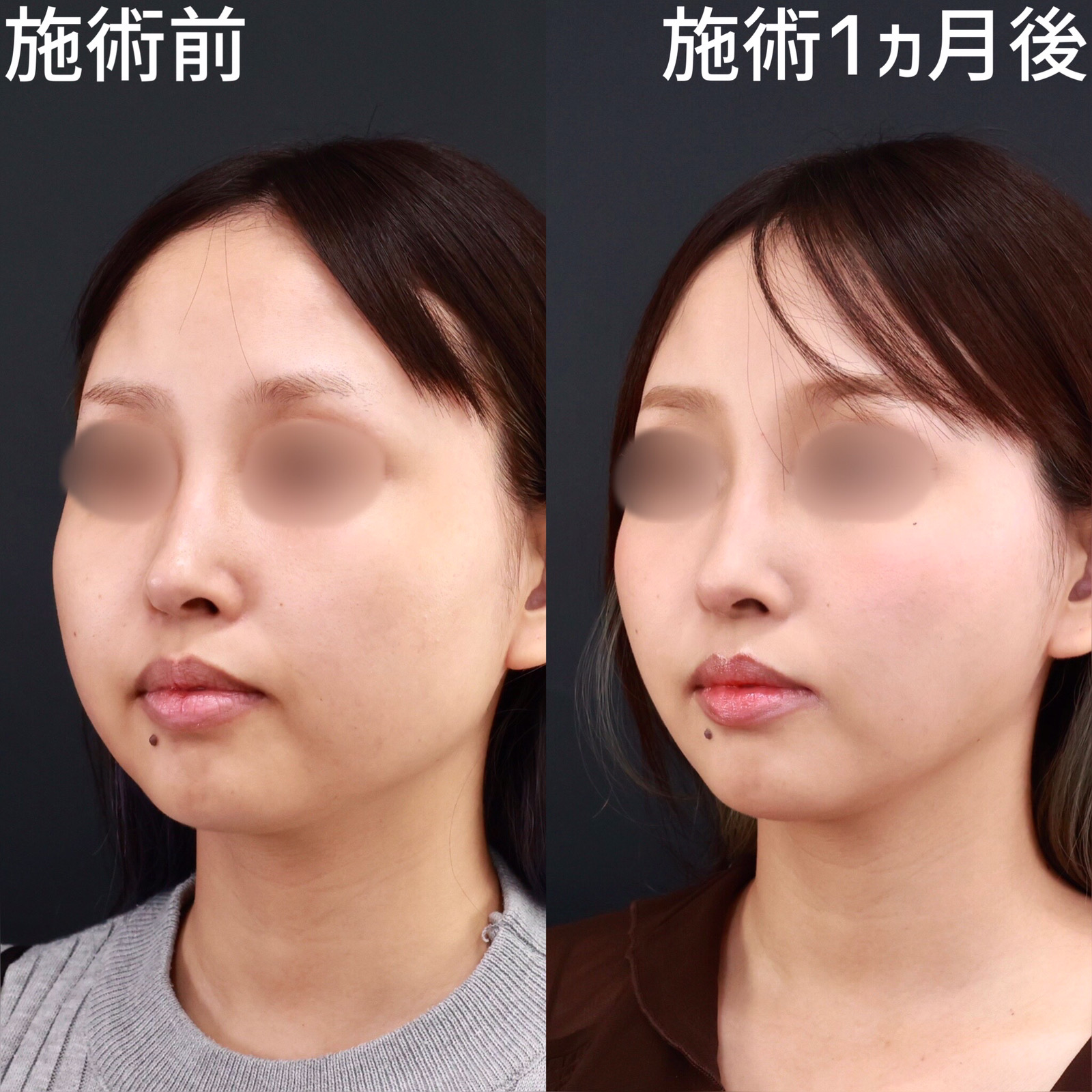 TAC式 ツヤ肌コラーゲンリフト®/エラボトックス注射の症例写真 施術前後 