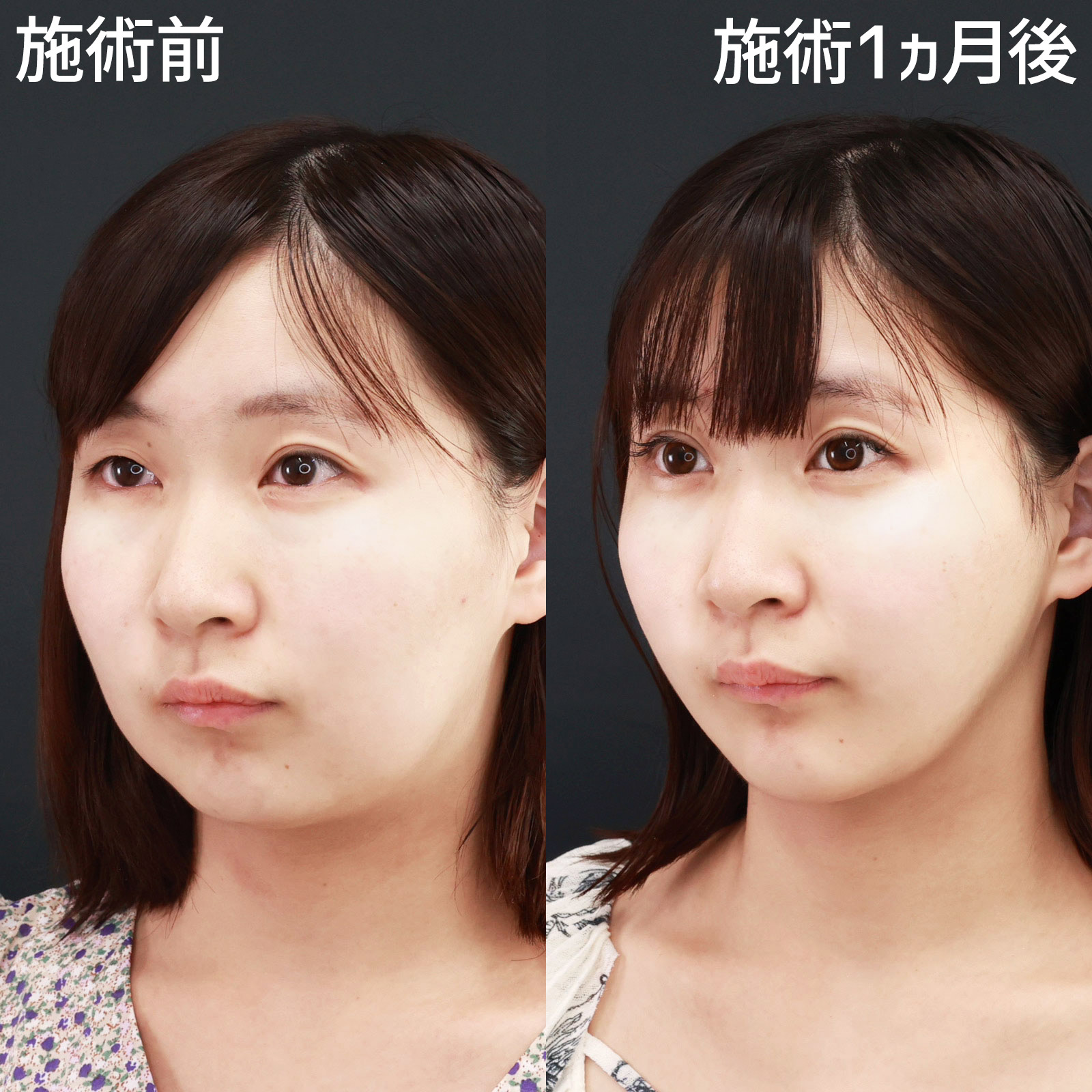 ジョールファット除去/Lラインファット除去（エラ下脂肪除去）/TAC式 ツヤ肌コラーゲンリフト®の症例写真 施術前後 