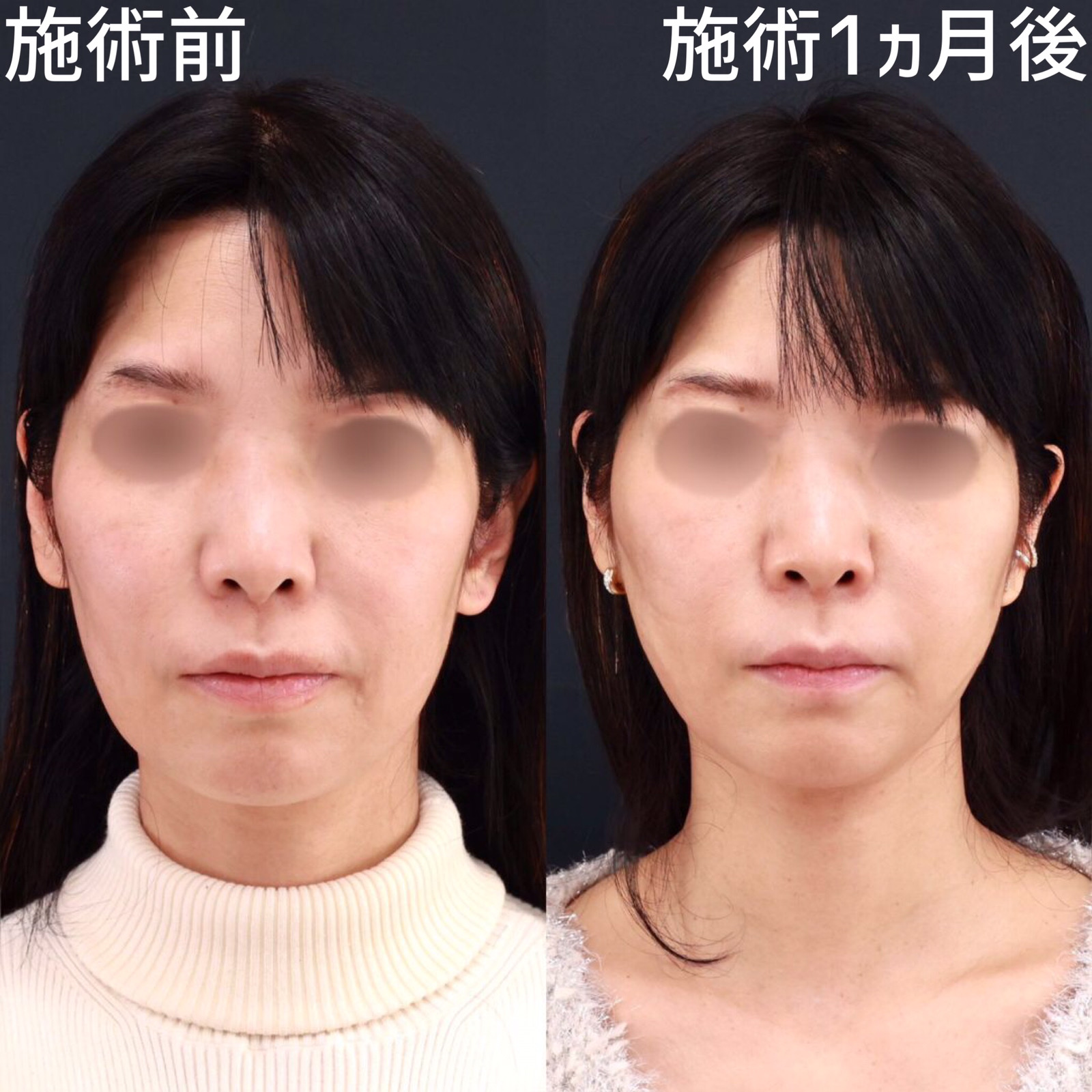 小顔 大阪の症例写真・画像・ビフォーアフター｜美容整形・美容