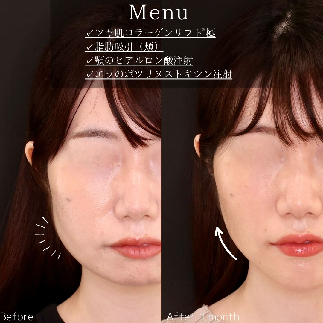 TAC式 ツヤ肌コラーゲンリフト®/顎下の脂肪吸引/顎のヒアルロン酸注射の症例写真 施術前後 