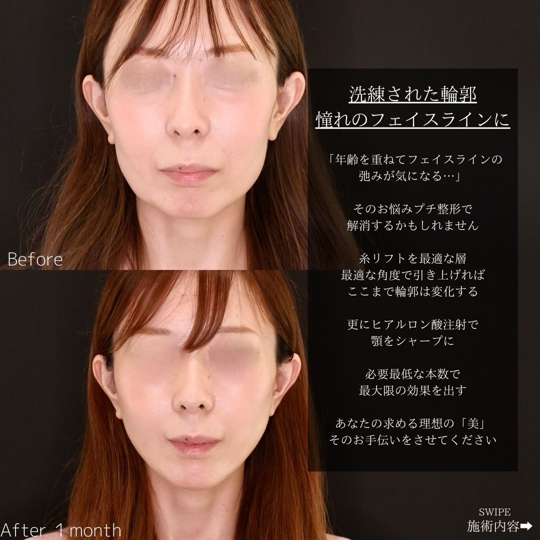 TAC式 ツヤ肌コラーゲンリフト®/顎のヒアルロン酸注射の症例写真 施術前後 