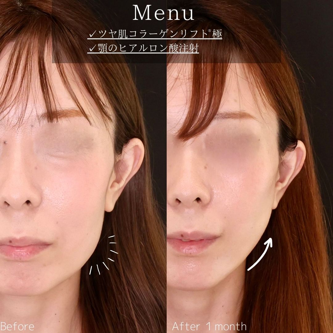 TAC式 ツヤ肌コラーゲンリフト®/顎のヒアルロン酸注射の症例写真 施術前後 