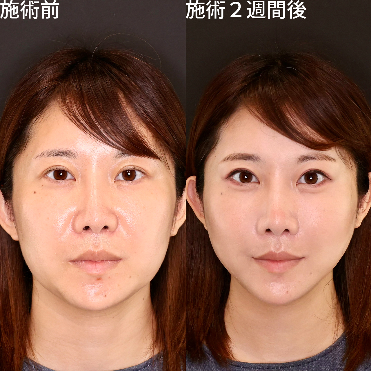 たった１施術で、この変化。即日小顔リフト