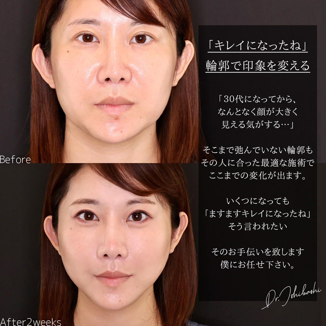 TAC式 ツヤ肌コラーゲンリフト®の症例写真 施術前後 