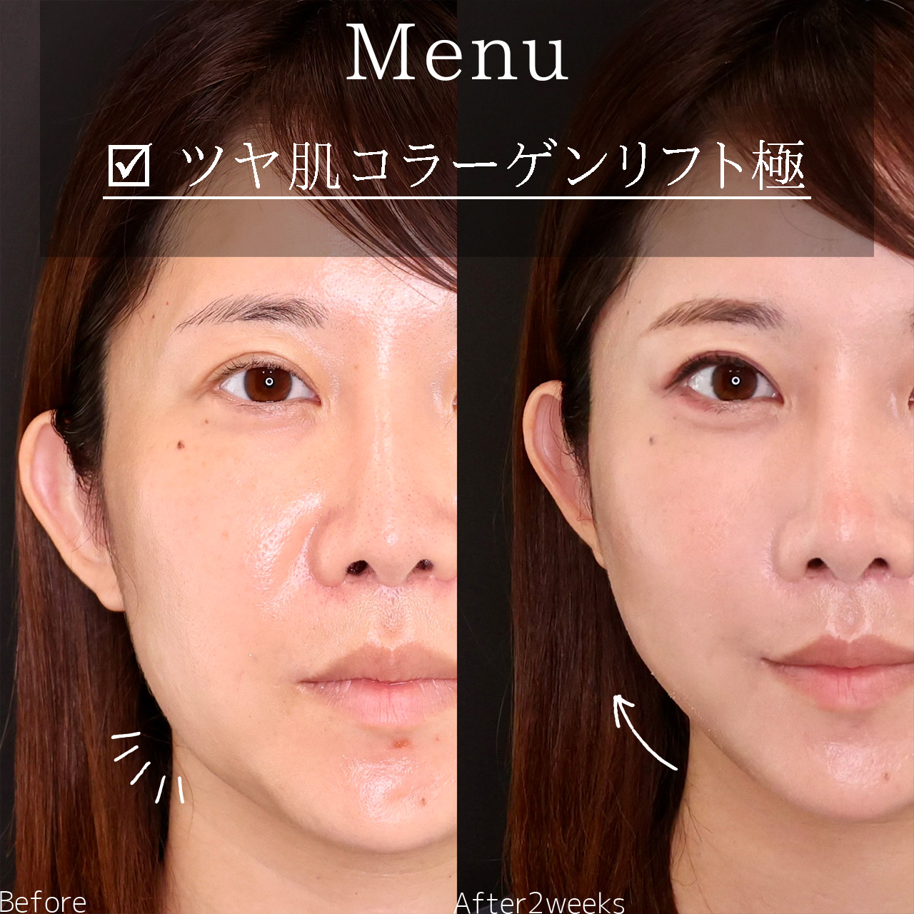 TAC式 ツヤ肌コラーゲンリフト®の症例写真 施術前後 