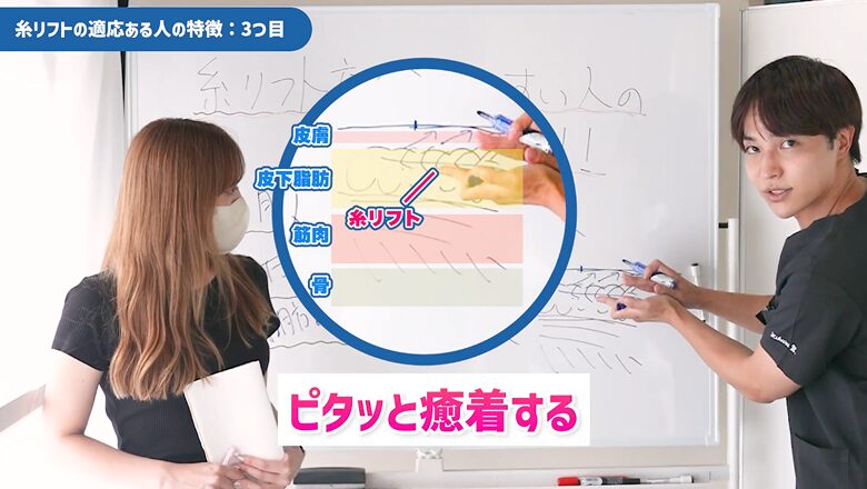 糸リフトが組織を引き上がて癒着する仕組みの図解