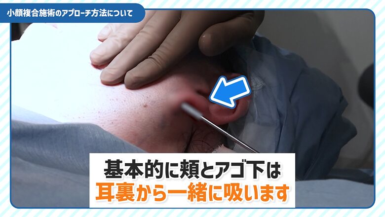 耳の裏から頬とアゴ下の脂肪を吸引する施術シーン