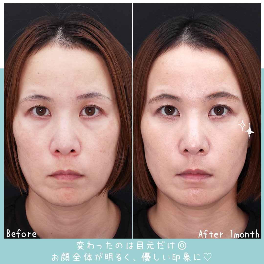 下眼瞼脱脂術（目の下のたるみ取り・目の下の脂肪ふくらみ取り）の症例写真 施術前後 