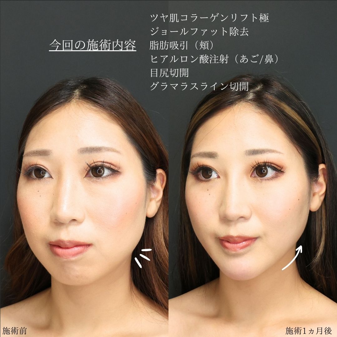 TAC式 ツヤ肌コラーゲンリフト®/ジョールファット除去/顔の脂肪吸引の症例写真 施術前後 