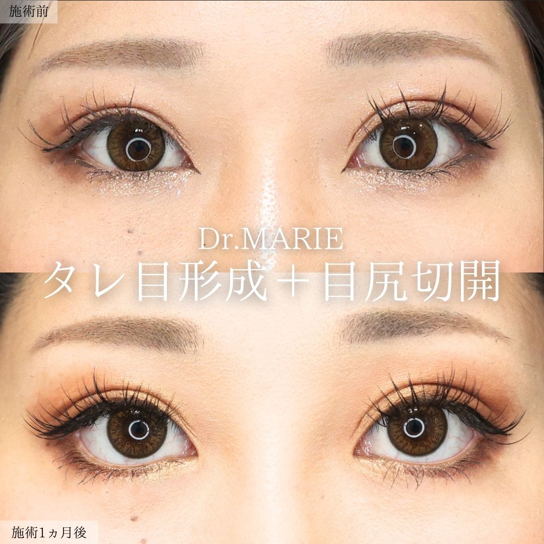 TAC式 ツヤ肌コラーゲンリフト®/ジョールファット除去/顔の脂肪吸引の症例写真 施術前後 