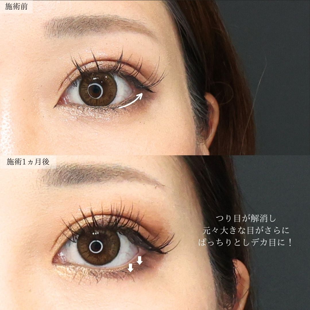 TAC式 ツヤ肌コラーゲンリフト®/ジョールファット除去/顔の脂肪吸引の症例写真 施術前後 