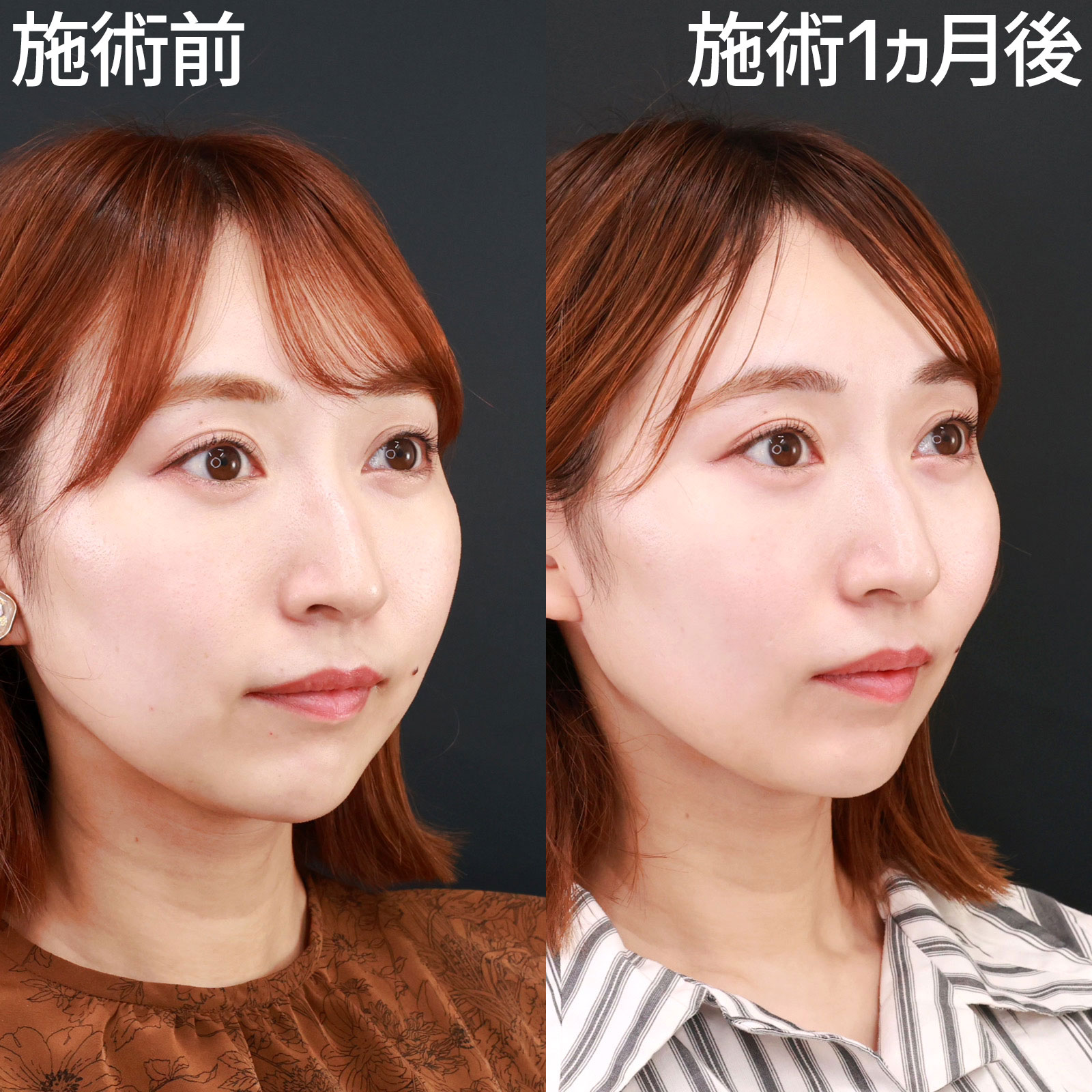 ジョールファット除去/ボトックス注射：その他/TAC式 ツヤ肌コラーゲンリフト®の症例写真 施術前後 