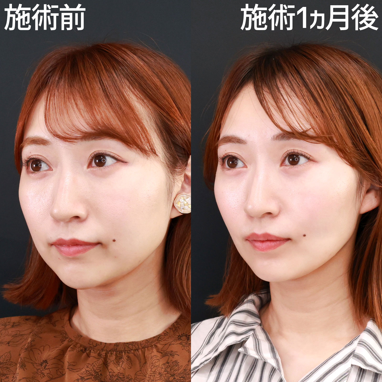 ジョールファット除去/ボトックス注射：その他/TAC式 ツヤ肌コラーゲンリフト®の症例写真 施術前後 