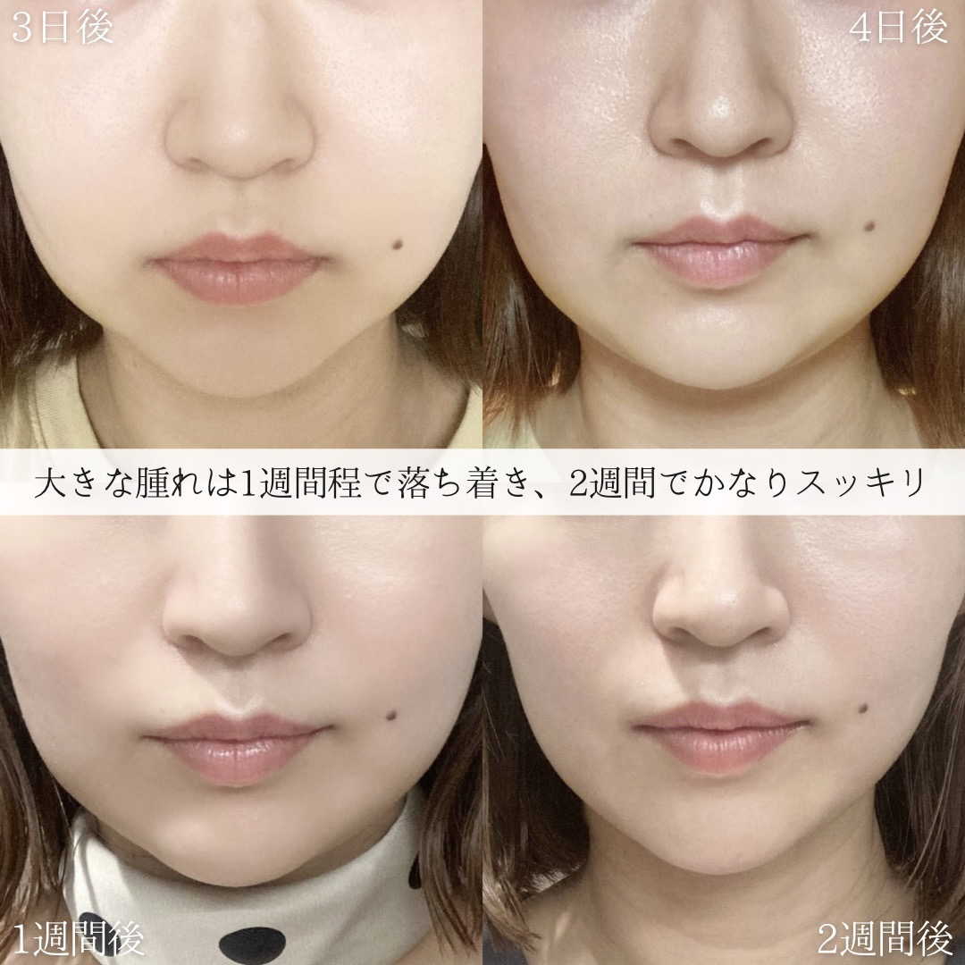 ジョールファット除去/ボトックス注射：その他/TAC式 ツヤ肌コラーゲンリフト®の症例写真 施術前後 