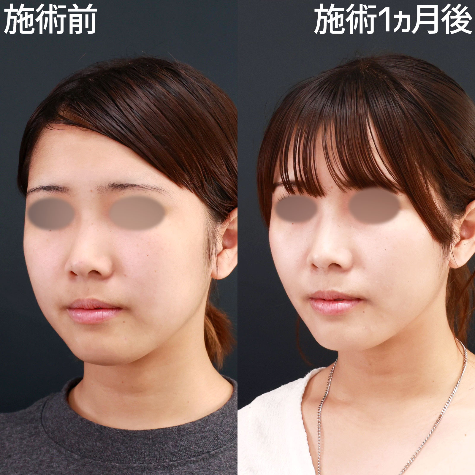 顔の脂肪吸引/ジョールファット除去の症例写真 施術前後 