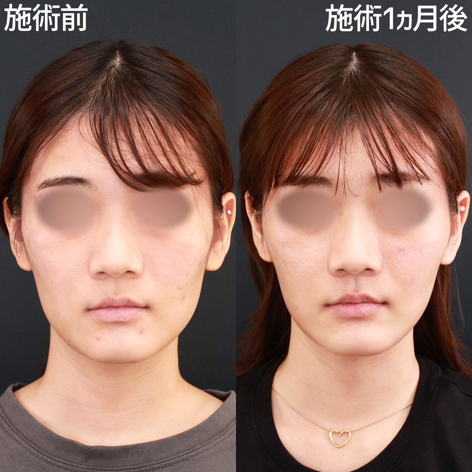 【糸リフト＆脂肪除去】お顔を一回り小さく、自然に垢抜ける小顔整形。