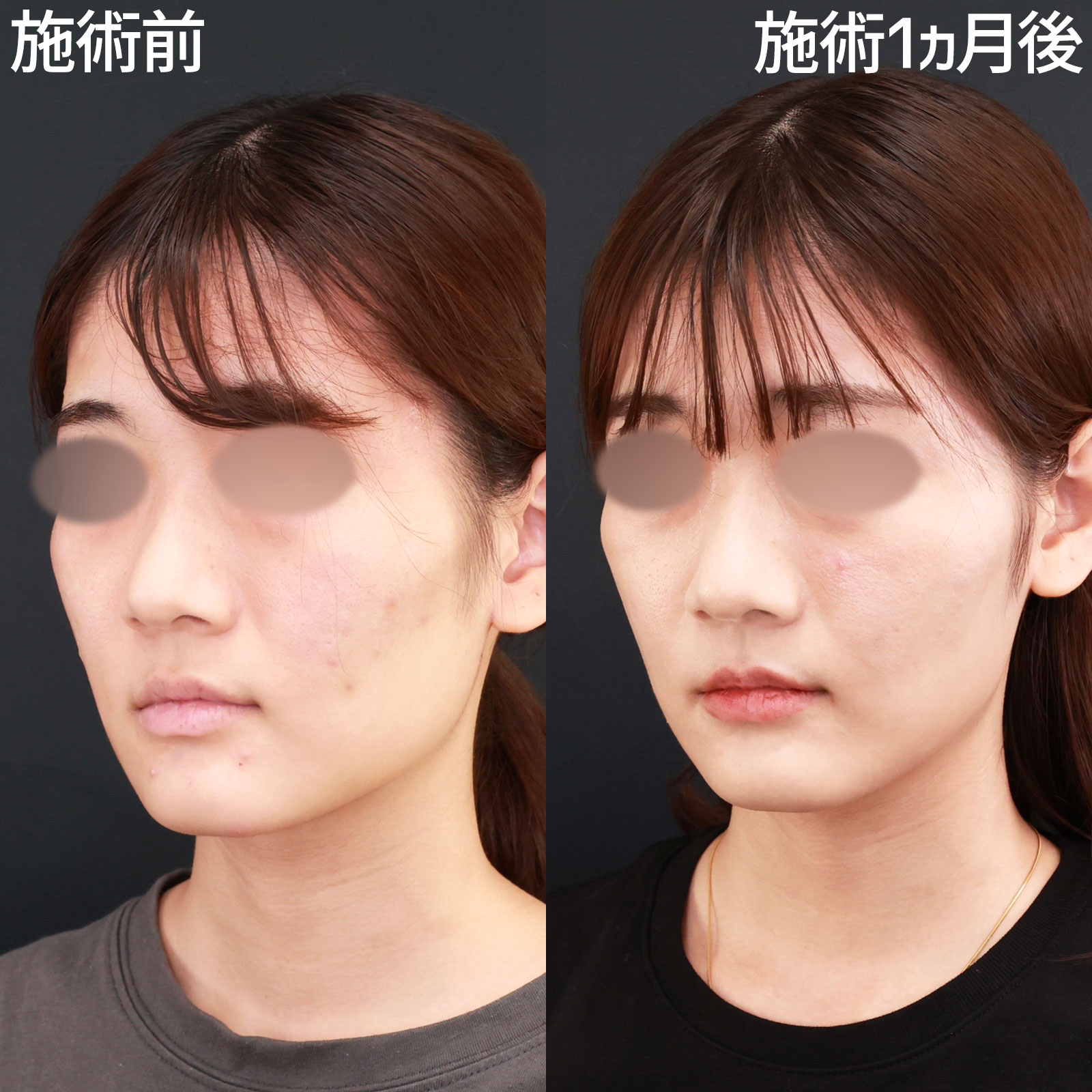 ジョールファット除去/TAC式 ツヤ肌コラーゲンリフト®/エラボトックス注射の症例写真 施術前後 