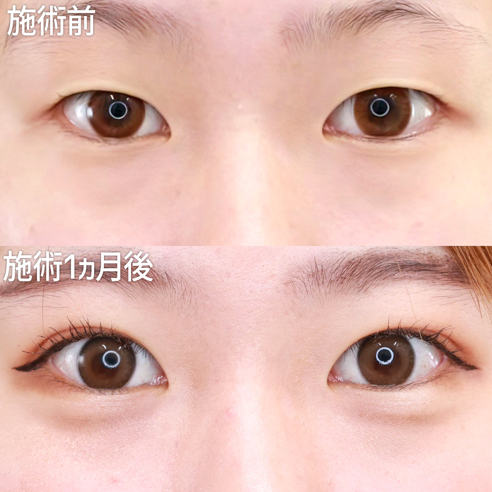 【二重埋没法】自然にスッキリ、目力アップ！可愛らしいMIX二重に大変身！！