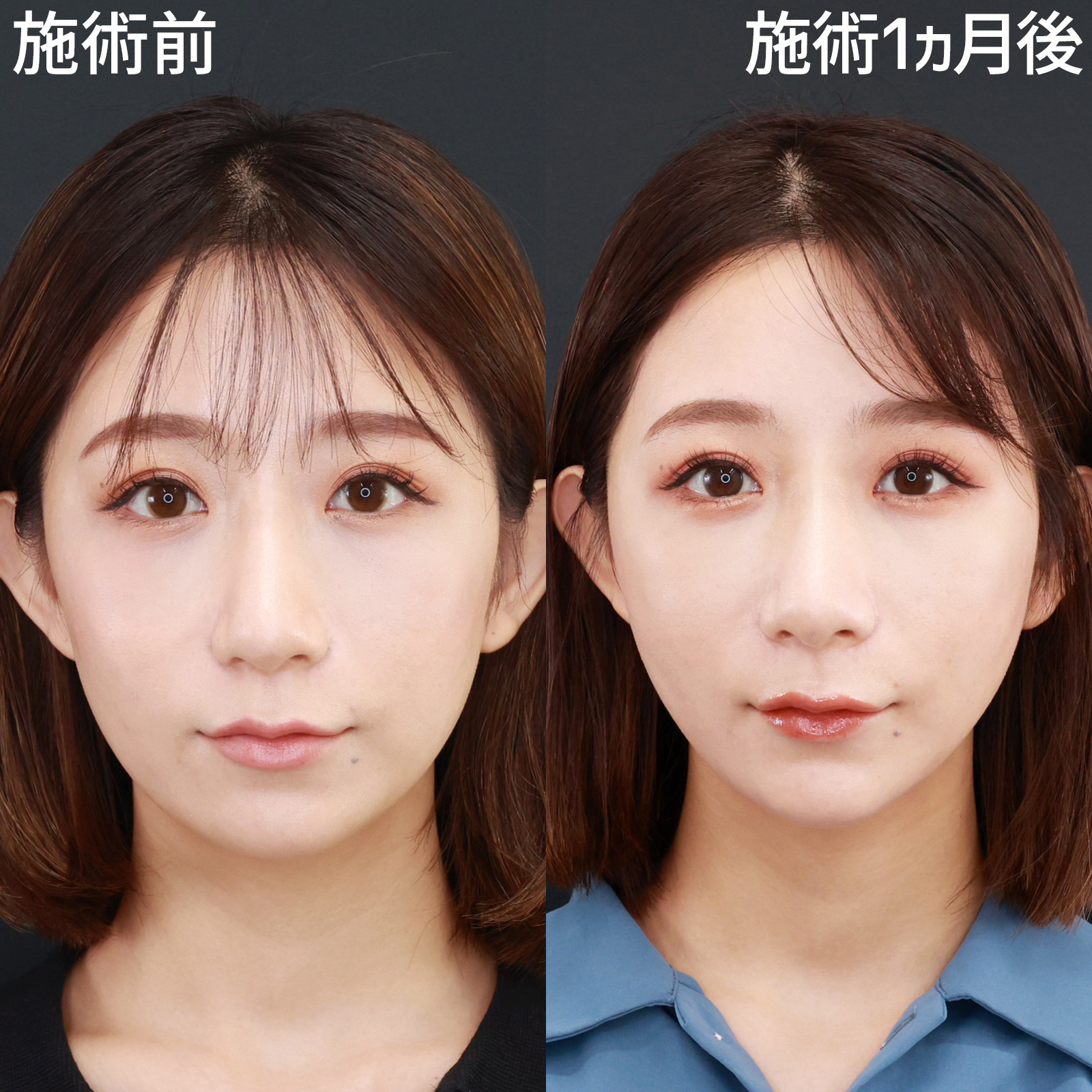 TAC式 ツヤ肌コラーゲンリフト®/顎のヒアルロン酸注射/ゴルゴ線のヒアルロン酸注射の症例写真 施術前後 