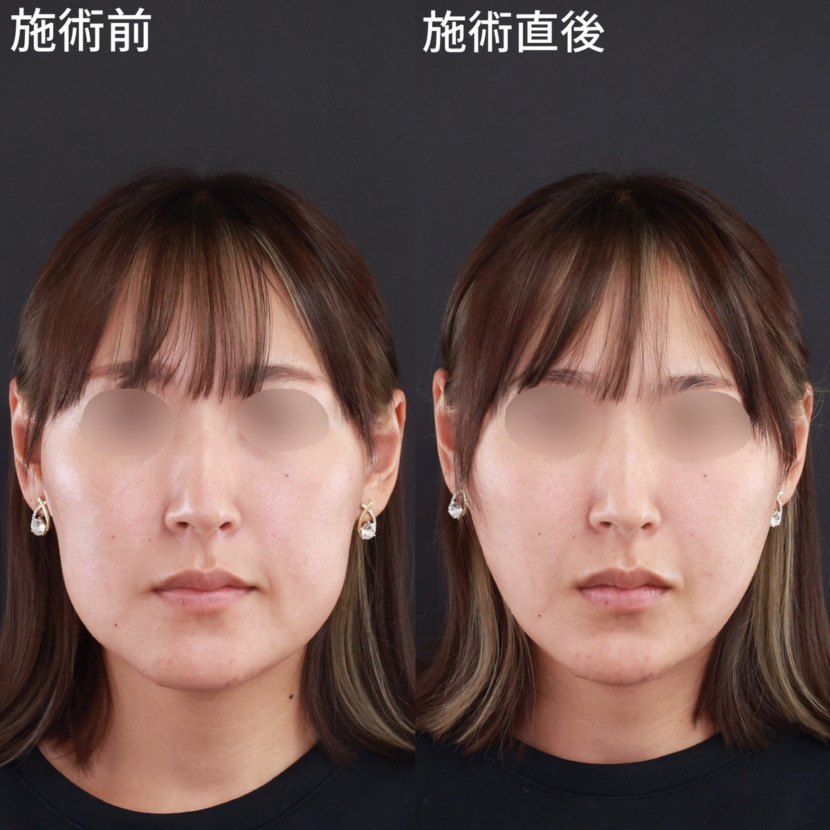 【小顔整形】ひょうたん型の輪郭から卵型の輪郭に