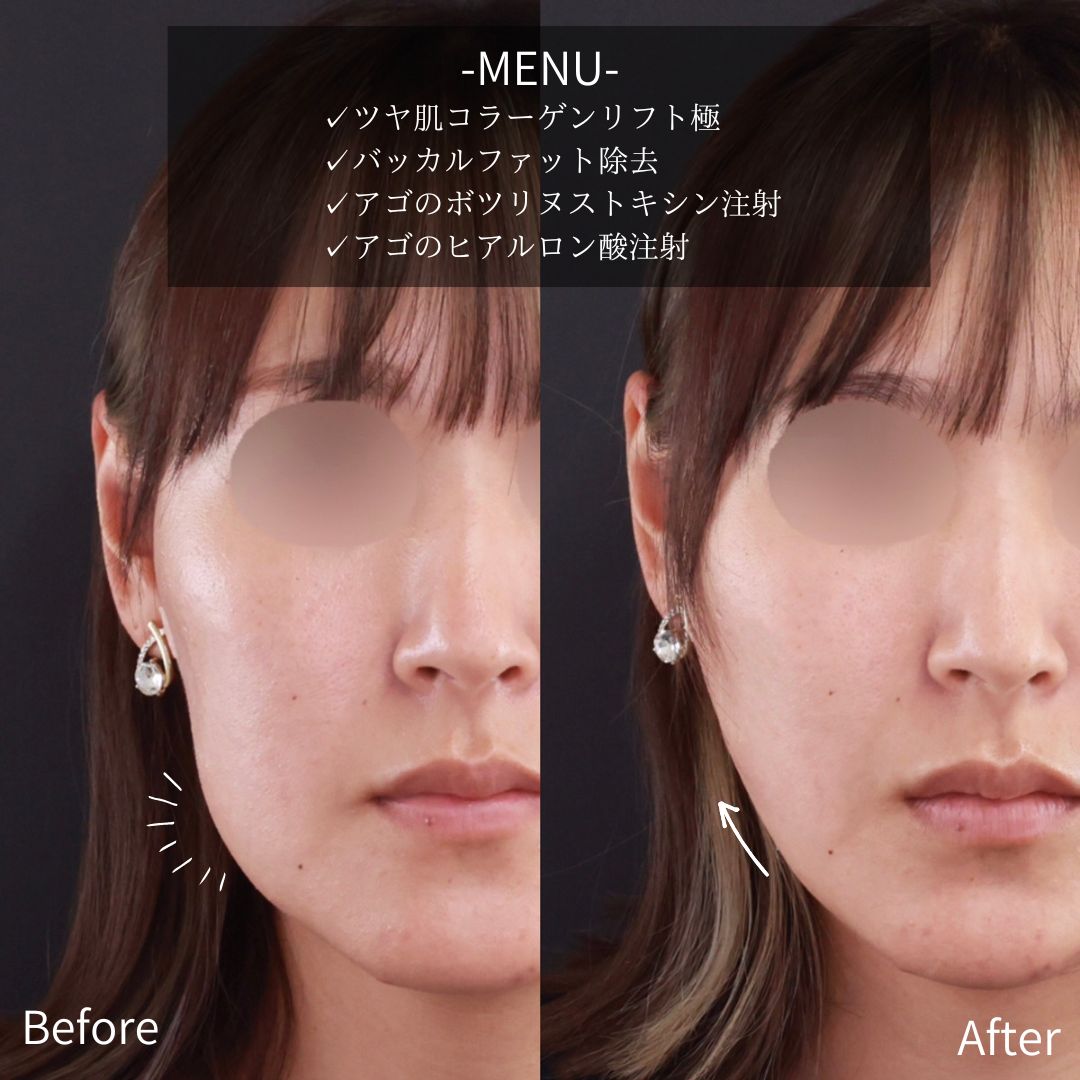 小顔整形｜パーフェクトフェイスライン/TAC式 ツヤ肌コラーゲンリフト®/ボトックス注射：その他の症例写真 施術前後 