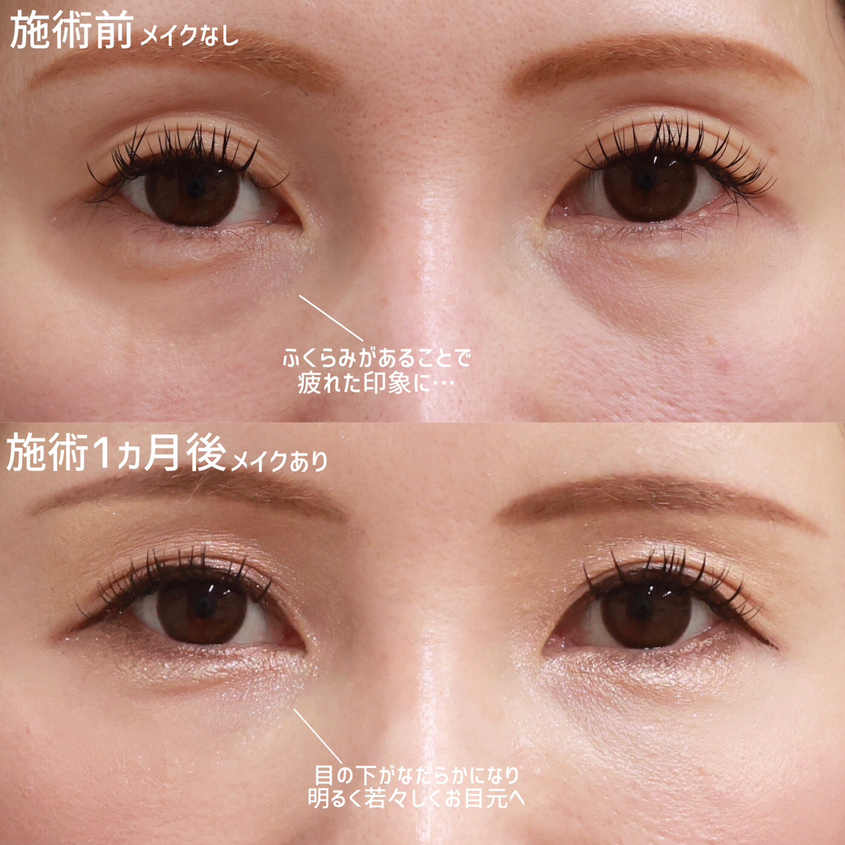 下眼瞼脱脂術（目の下のたるみ取り・目の下の脂肪ふくらみ取り）/顔の脂肪注入(コンデンスリッチフェイス)の症例写真 施術前後 