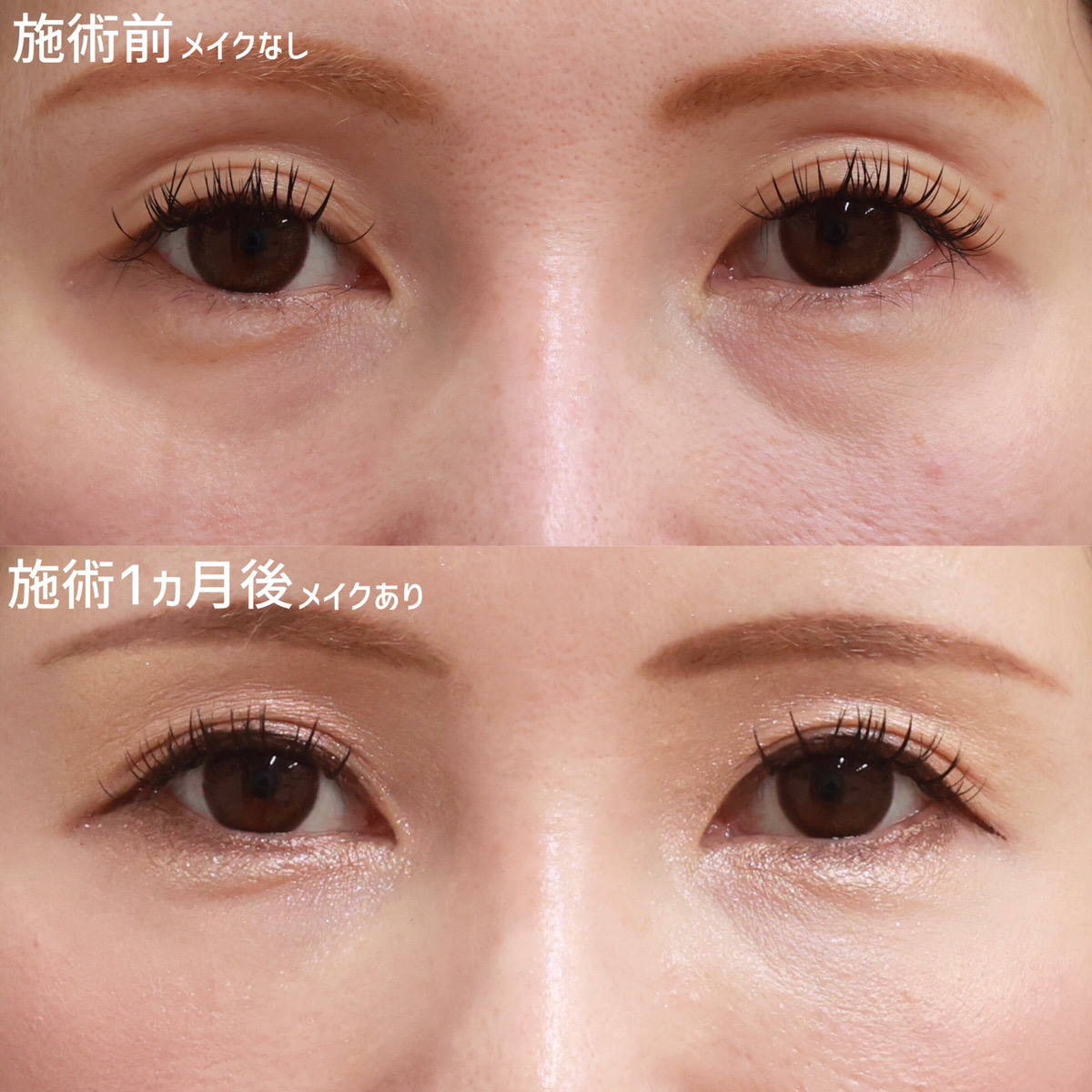 【クマ取り】疲れ顔を卒業し、明るく華やかな目元へ