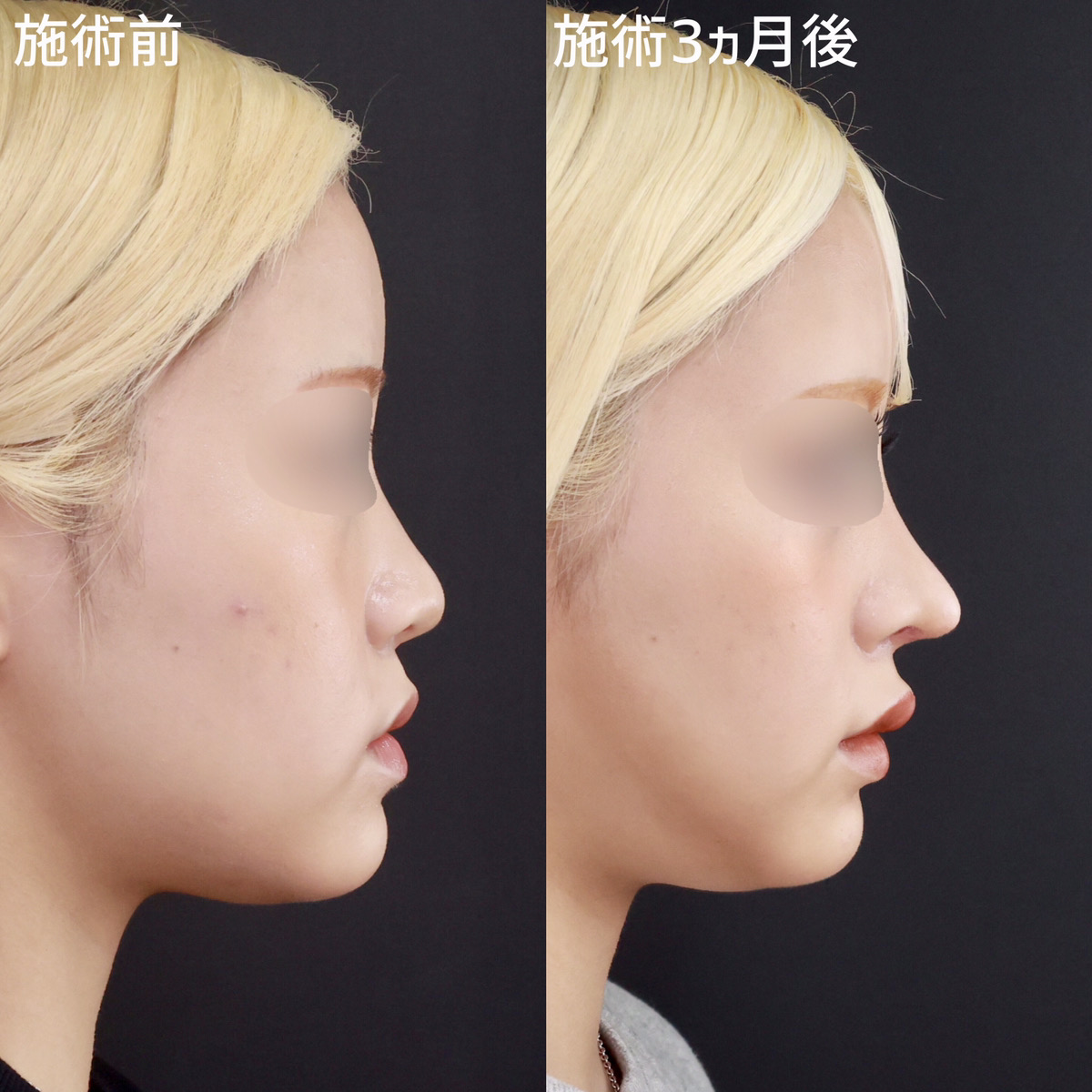 鼻中隔延長術/鼻先軟骨移植/鼻尖形成・鼻尖縮小の症例写真 施術前後