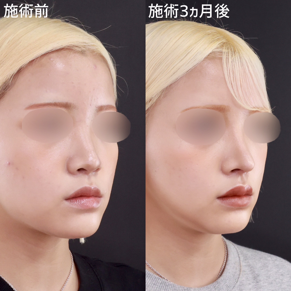 鼻中隔延長術/鼻先軟骨移植/鼻尖形成・鼻尖縮小の症例写真 施術前後