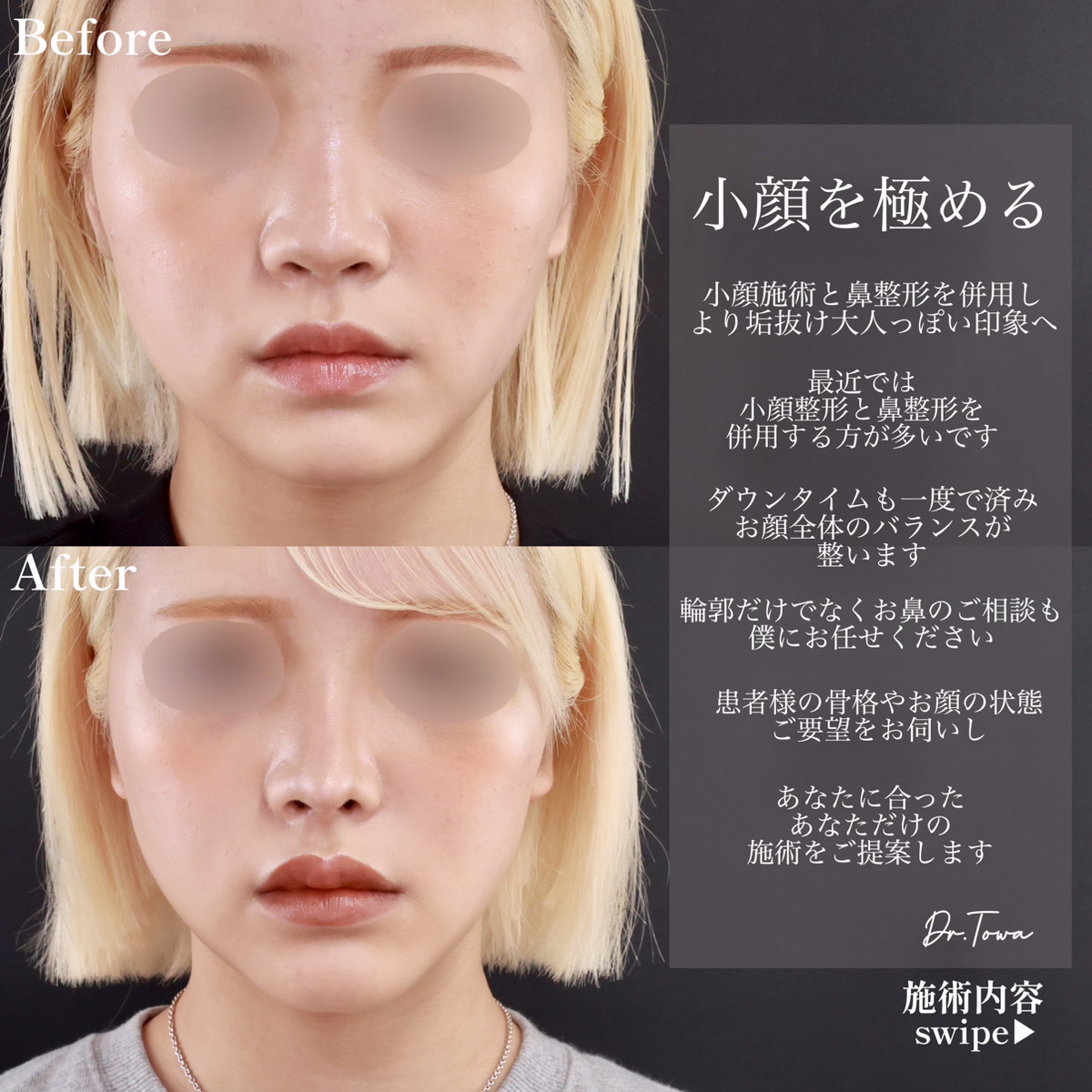 鼻中隔延長術/鼻先軟骨移植/鼻尖形成・鼻尖縮小の症例写真 施術前後