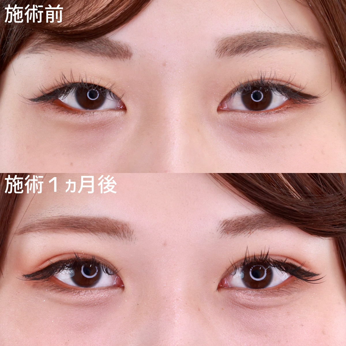 夏休みの間に私が垢抜けた方法【二重埋没法】